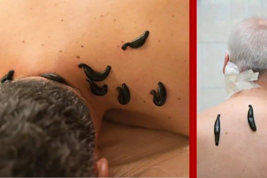 leech therapy in Gurgaon